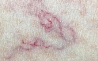 Паутинные вены: Причины и профилактика